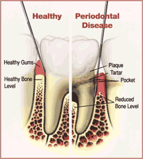 Healthy vs. periodontal disease tooth