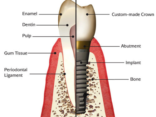 structure of the dental implant