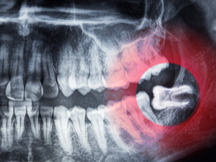 dental x ray of an impacted wisdom tooth in need of a tooth extraction